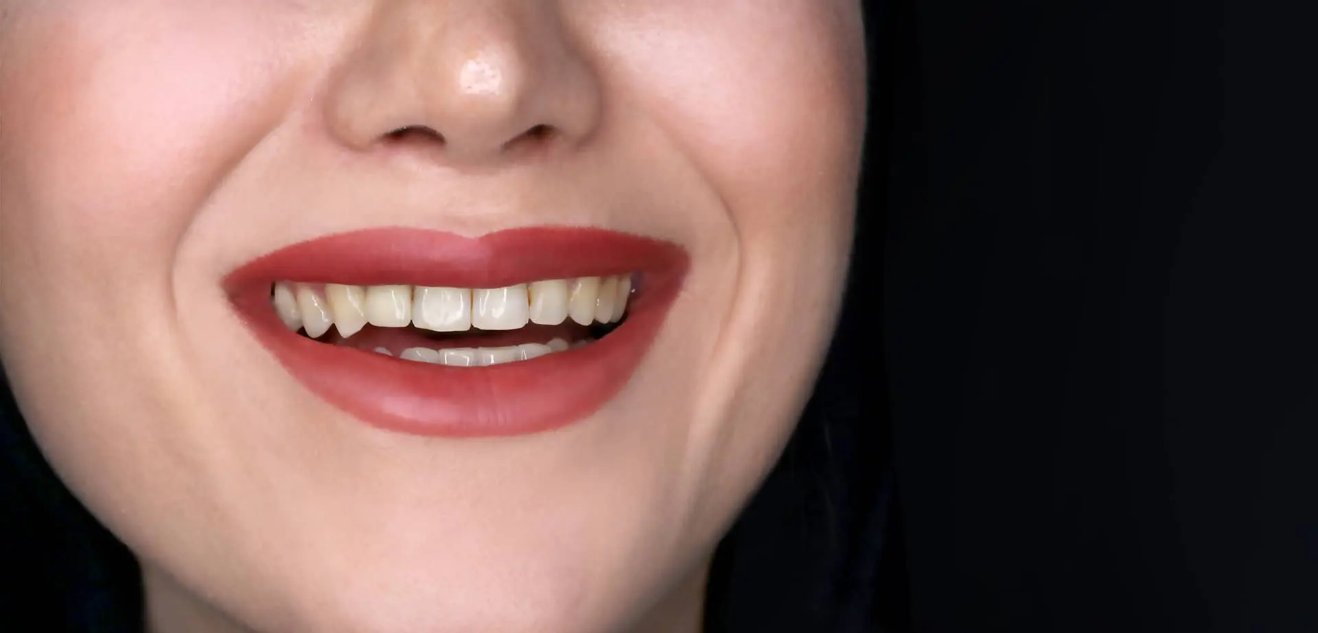 قبل از لمینت