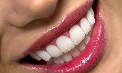 نمونه کامپوزیت دندانپزشکی لوتوس