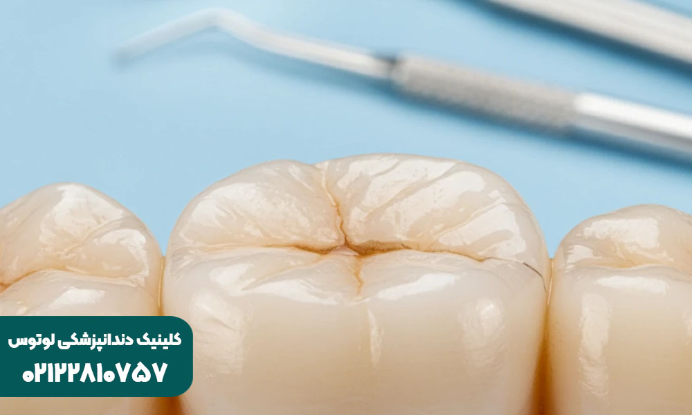 ترمیم ترک خوردگی دندان