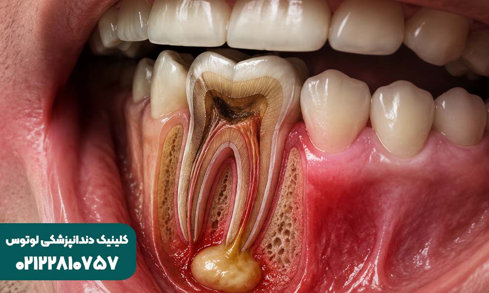 درمان آبسه دندان در کودکان + علائم و عوارض عفونت دندان شیری