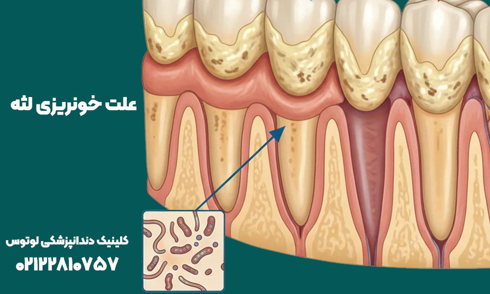 دلیل خونریزی لثه چیست