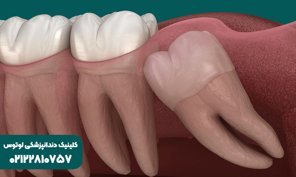 دندان عقل چیست
