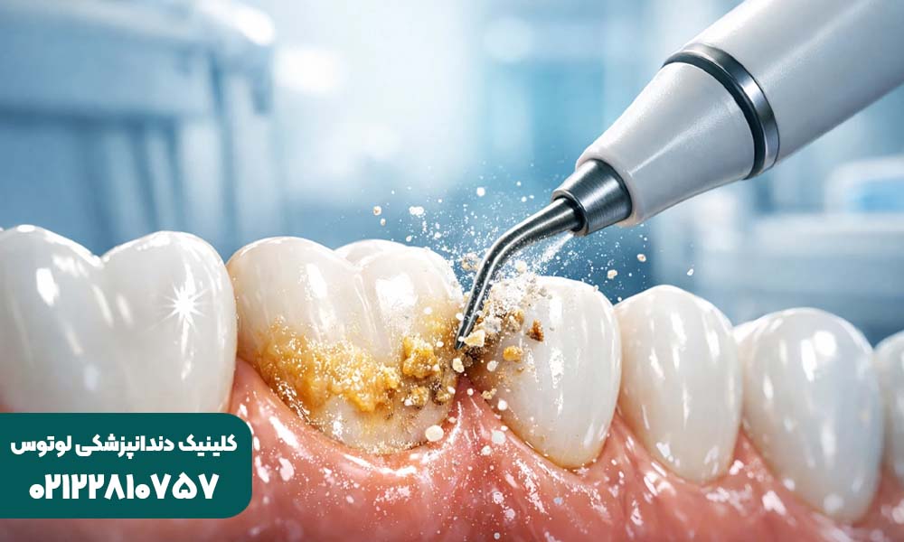 روش جرم گیری دندان در خانه