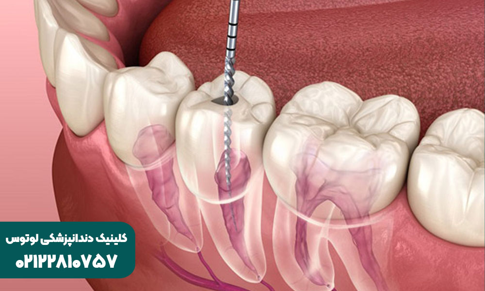 علائم نیاز به عصب کشی دندان