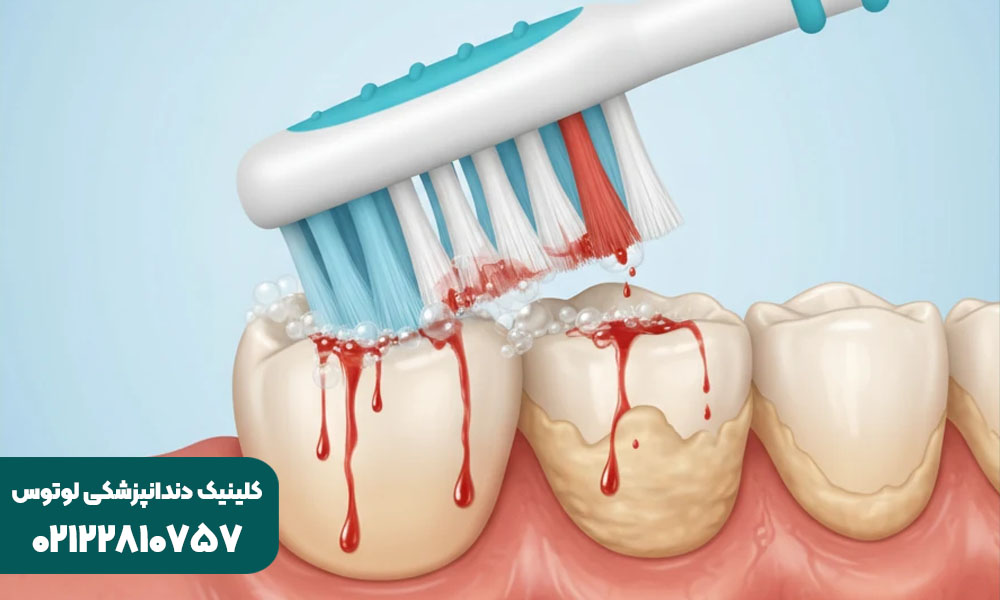 خونریزی لثه هنگام مسواک زدن نشانه چیست؟