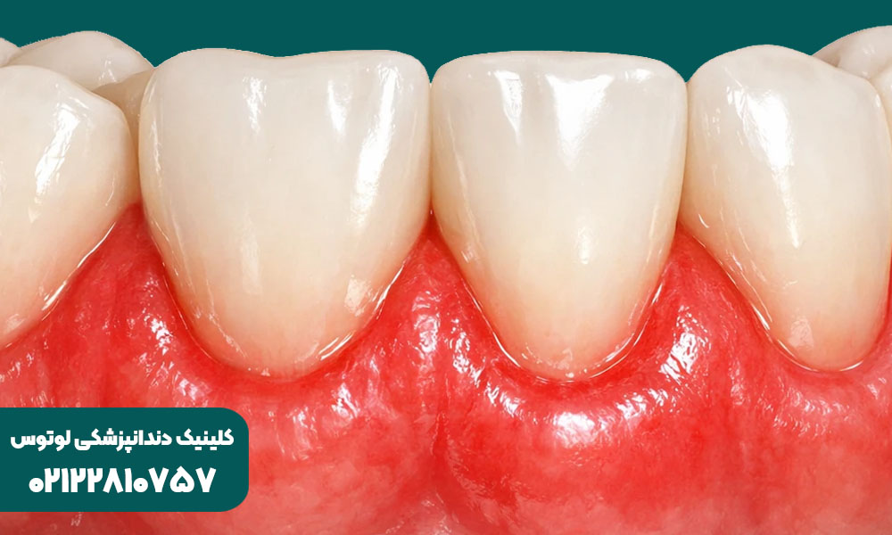 فرق التهاب و عفونت لثه