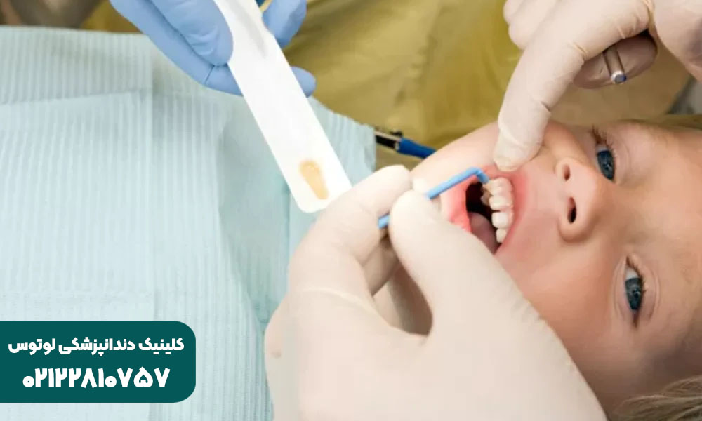 فلورایدتراپی دندان کودک