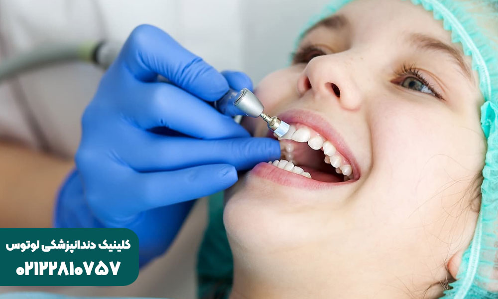 فلورایدتراپی دندان